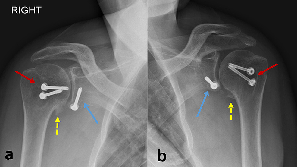 Conjoint Tendon Shoulder Anatomy - The Shoulder Musculoskeletal Key ...