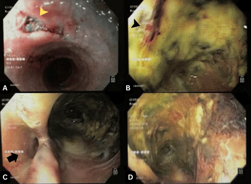 does vape cause acid reflux Do Nic Salts Cause Acid Reflux? main image 1