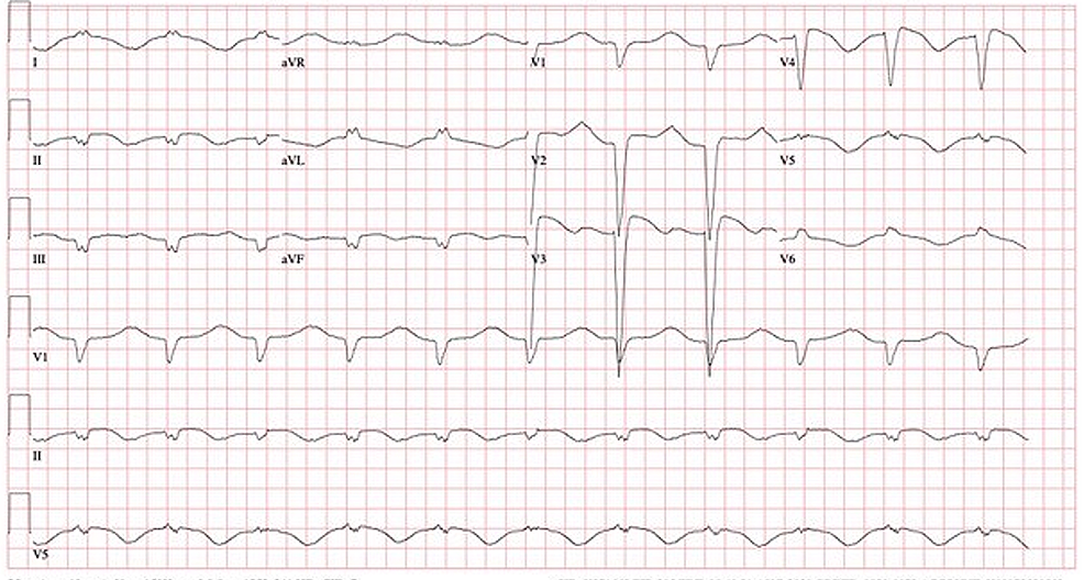 Cureus | A Rare Case of COVID-19 Myocarditis With Cardiac Tamponade in ...