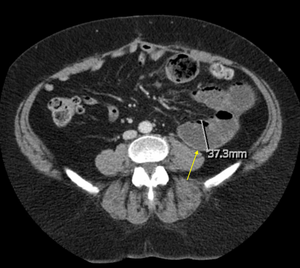 can glp 1 cause bowel obstruction Weighing the Risks: Small Bowel Obstruction Associated With Semaglutide Use  in the Postoperative Abdomen