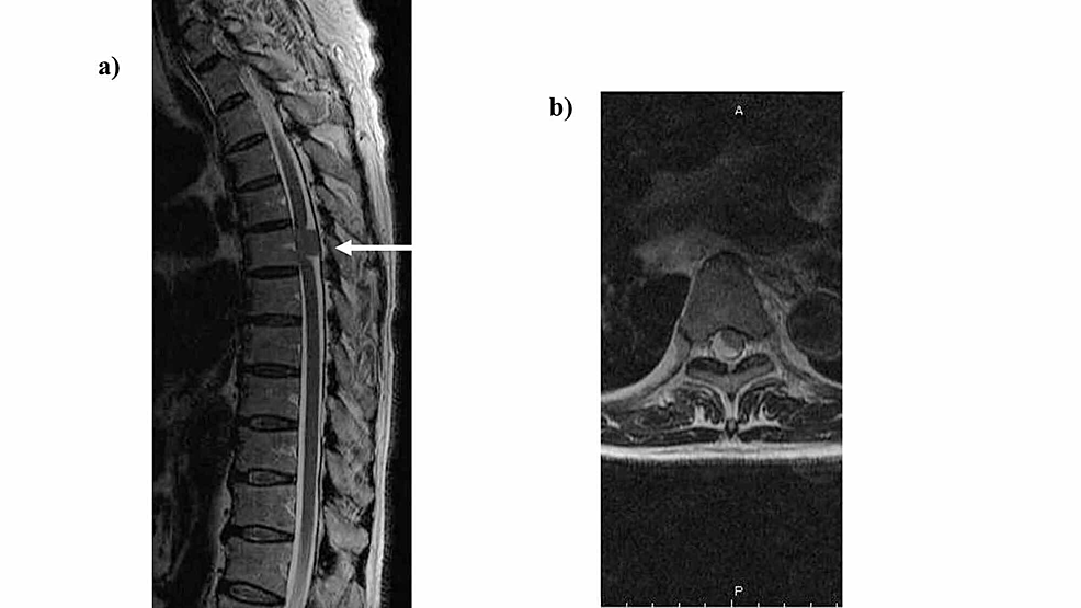 Thoracic-spine-intradural-extramedullary-tumor-(Th6).-Preoperative-images.