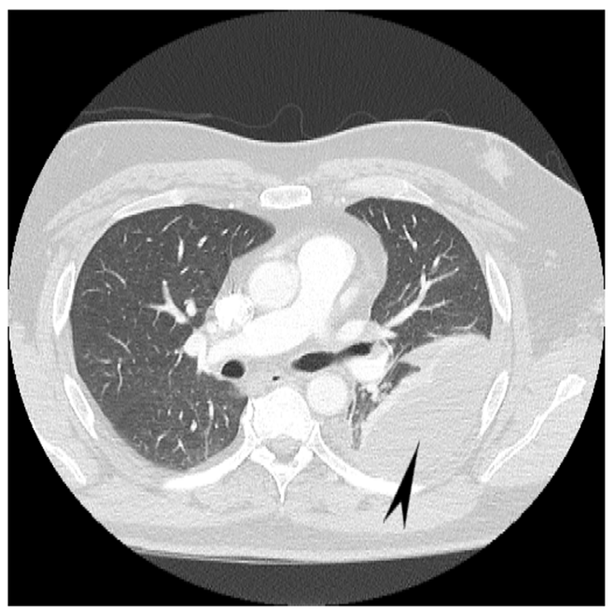 Cureus Hemorrhagic Pleural Effusion A Rare Presentation Of Vitamin K Deficiency In An Adult