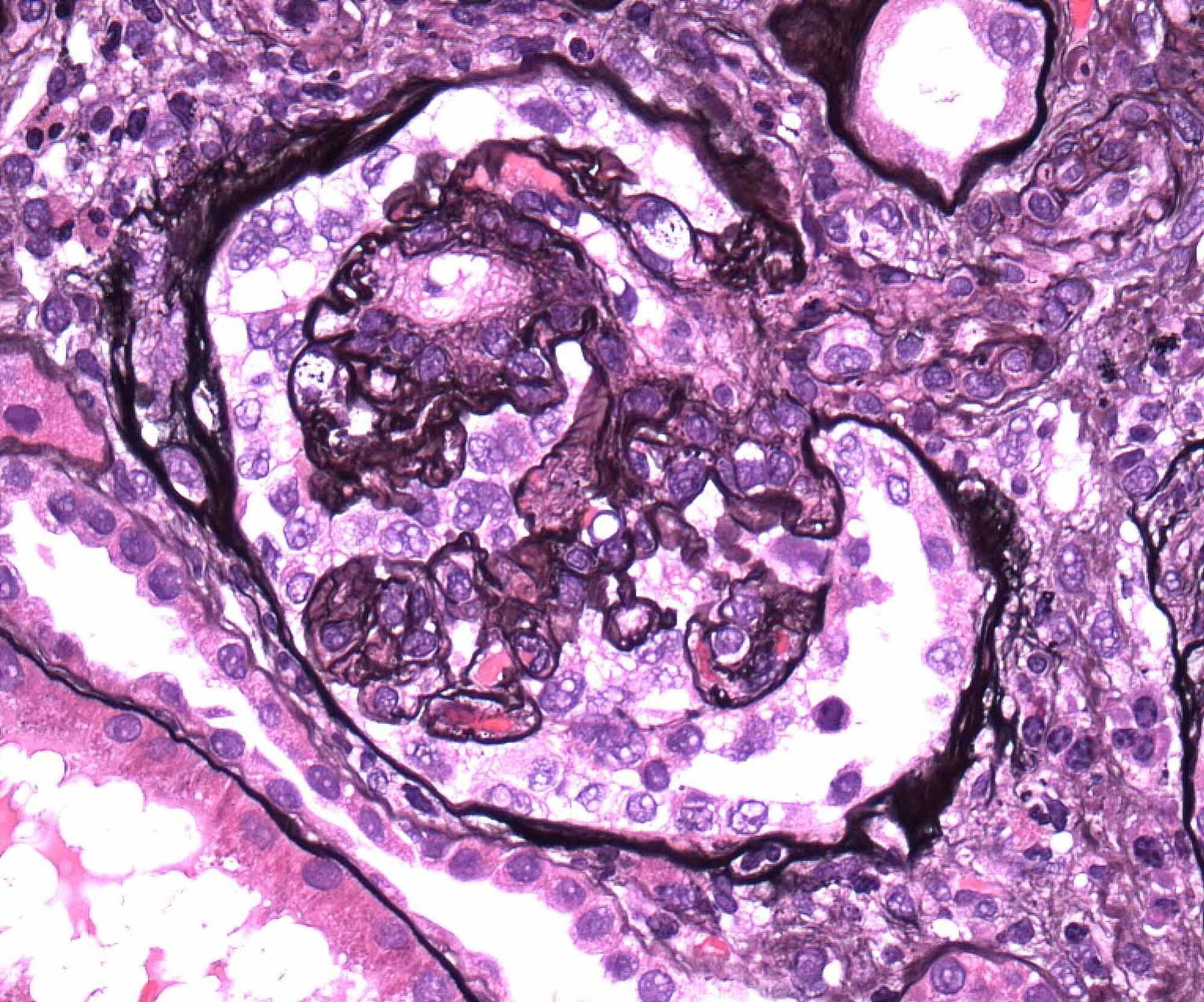 Cureus | Severe Acute Respiratory Syndrome Coronavirus 2 Induced Focal ...