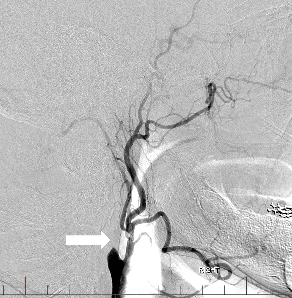 internal carotid artery angiogram