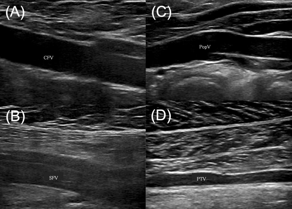 Lower-extremity-venous-ultrasound-images-before-fracture-surgery,-demonstrating-no-deep-vein-thrombosis
