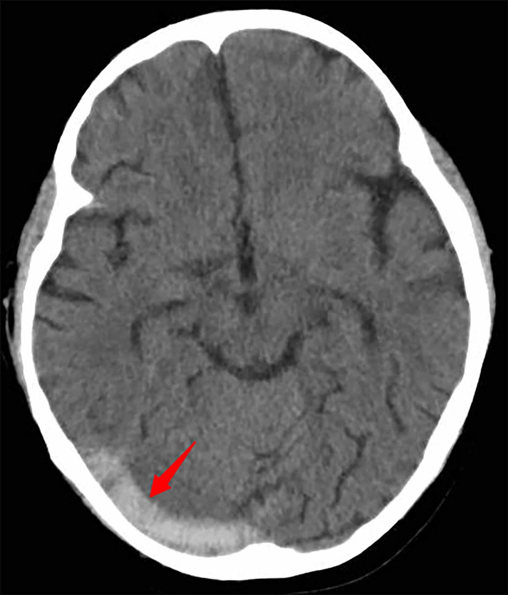 Cureus Cerebral Venous Sinus Thrombosis In A Child With Idiopathic Nephrotic Syndrome A Case Report And Review Of The Literature