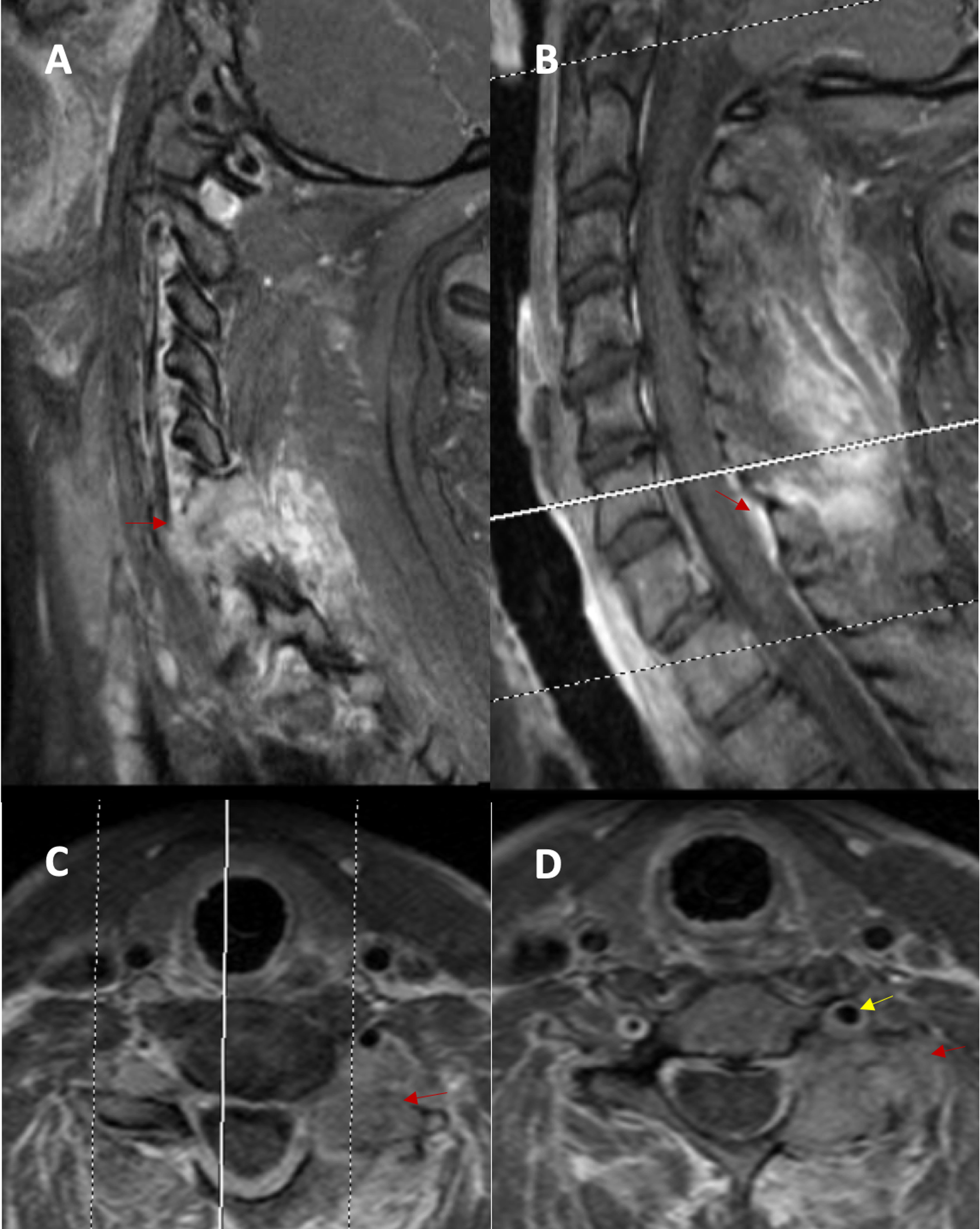 Cureus Tenosynovial Giant Cell Tumor of the Cervical Spine Case