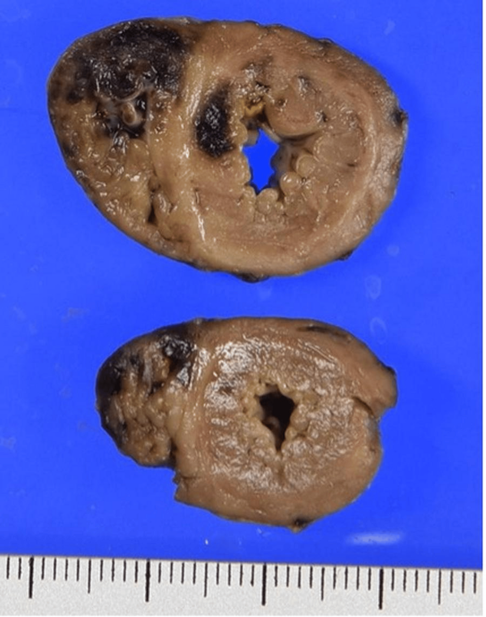 Cross-sections-of-the-heart-showing-dark-reddish-hemorrhage-and-yellowish-necrosis,-mainly-in-the-right-ventricle-and-ventricular-septum Cross-sections-of-the-heart-showing-dark-reddish-hemorrhage-and-yellowish-necrosis,-mainly-in-the-right-ventricle-and-ventricular-septum