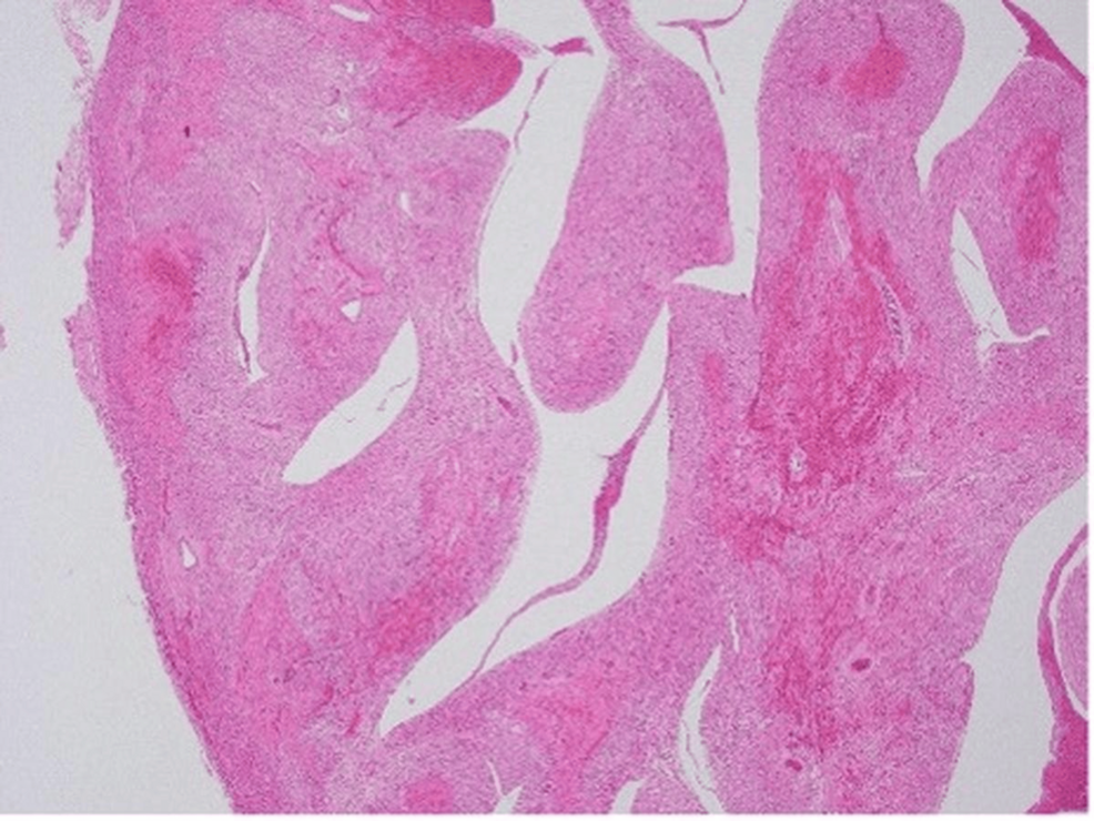 Irregularly-shaped-hemorrhagic-and-necrotic-foci-confirmed-throughout-the-epicardium-to-endocardium-of-the-myocardial-wall-(hematoxylin-and-eosin-stain,-original-magnification-×40) Irregularly-shaped-hemorrhagic-and-necrotic-foci-confirmed-throughout-the-epicardium-to-endocardium-of-the-myocardial-wall-(hematoxylin-and-eosin-stain,-original-magnification-×40)