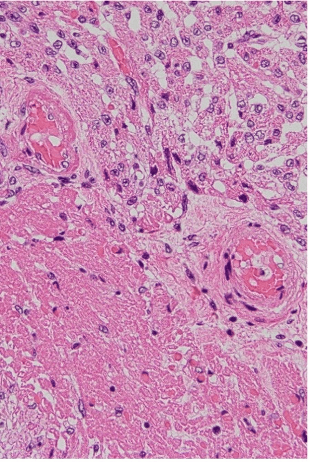 Fibrinoid-degeneration-in-small-vessels-observed-in-the-areas-of-hemorrhagic-necrosis-of-the-myocardium-(hematoxylin-and-eosin-stain,-original-magnification-×200) Fibrinoid-degeneration-in-small-vessels-observed-in-the-areas-of-hemorrhagic-necrosis-of-the-myocardium-(hematoxylin-and-eosin-stain,-original-magnification-×200)