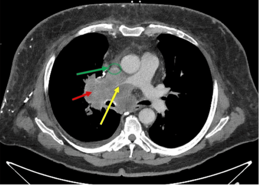 Chest-CT-scan-with-contrast-(axial-section)-showing-compression-of-the-superior-vena-cava-and-right-pulmonary-artery- Chest-CT-scan-with-contrast-(axial-section)-showing-compression-of-the-superior-vena-cava-and-right-pulmonary-artery-
