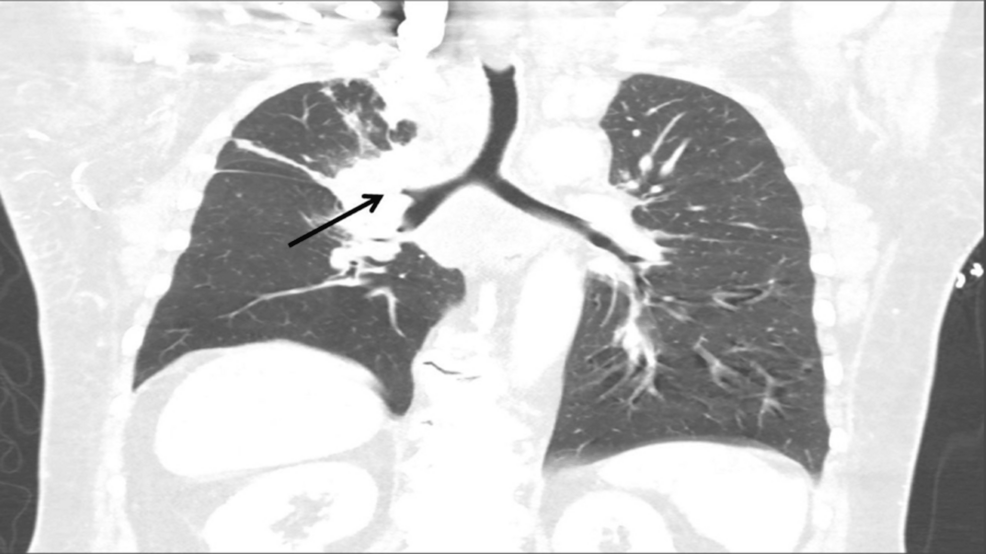 Chest-CT-scan-(coronal-view)-showing-compression-of-the-right-upper-lobe-bronchus Chest-CT-scan-(coronal-view)-showing-compression-of-the-right-upper-lobe-bronchus