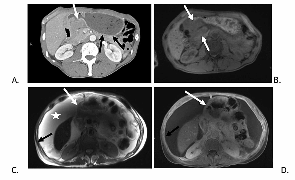 Definitive Chemoradiation With Dose Escalation for Locally Advanced ...