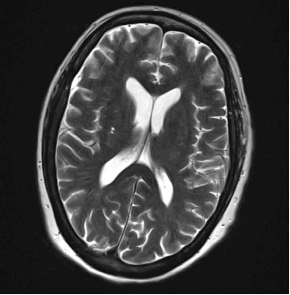 Brain-MRI-of-the-patient-one-day-after-admission Brain-MRI-of-the-patient-one-day-after-admission