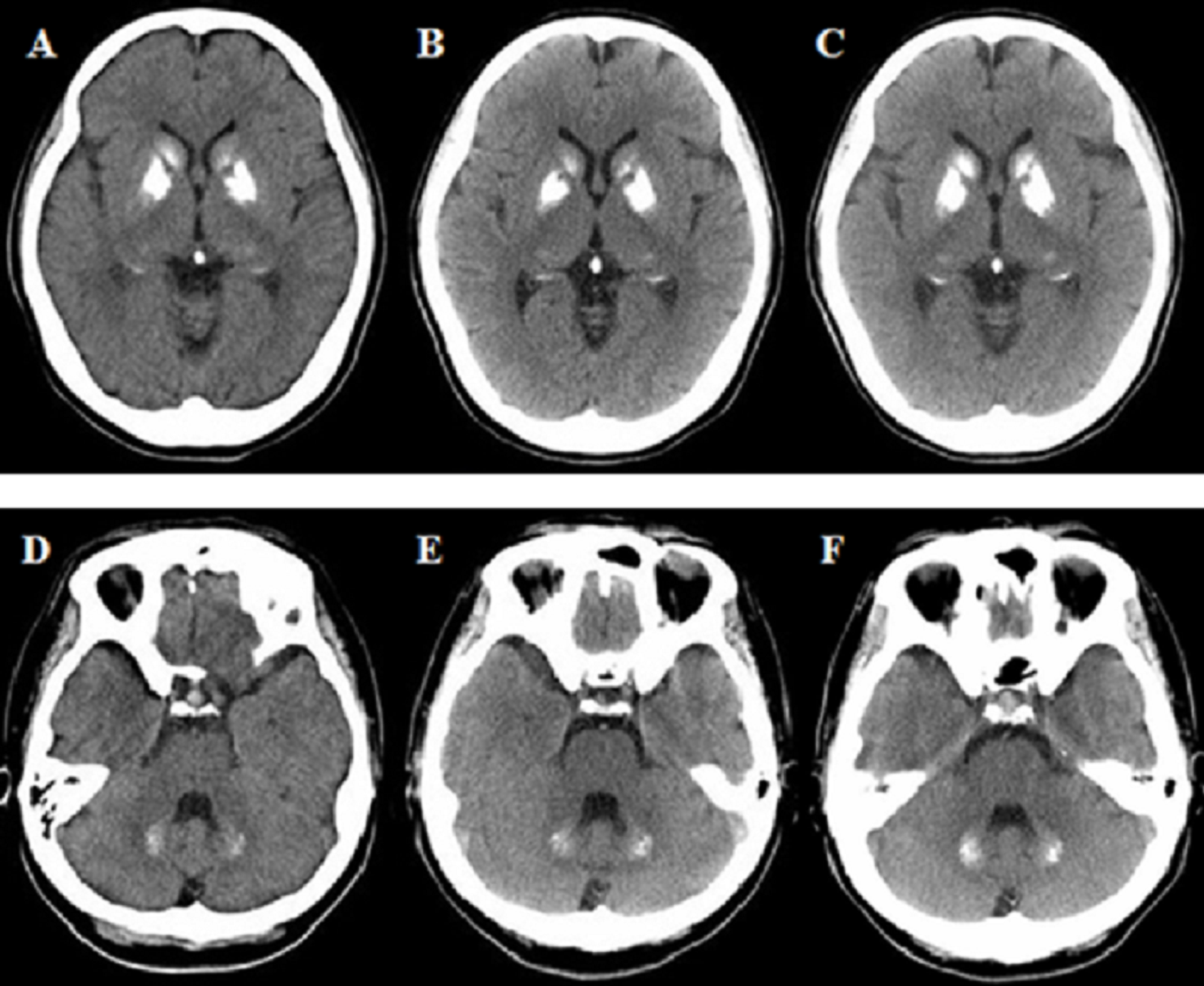 Cureus | SLC20A2-Associated Idiopathic Basal Ganglia Calcification ...