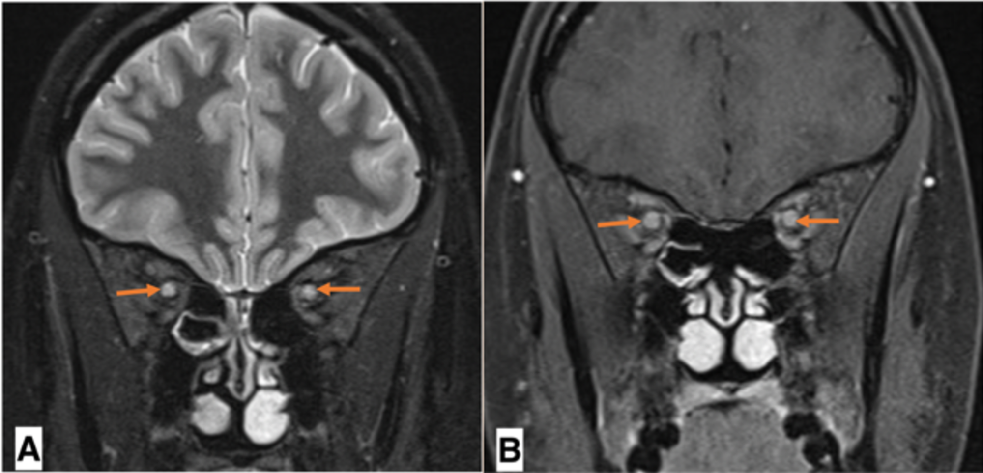 cureus-severe-bilateral-optic-neuritis-a-rare-presentation-of