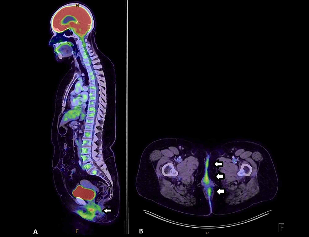 Extensive Extramammary Paget’s Disease With Underlying Perianal
