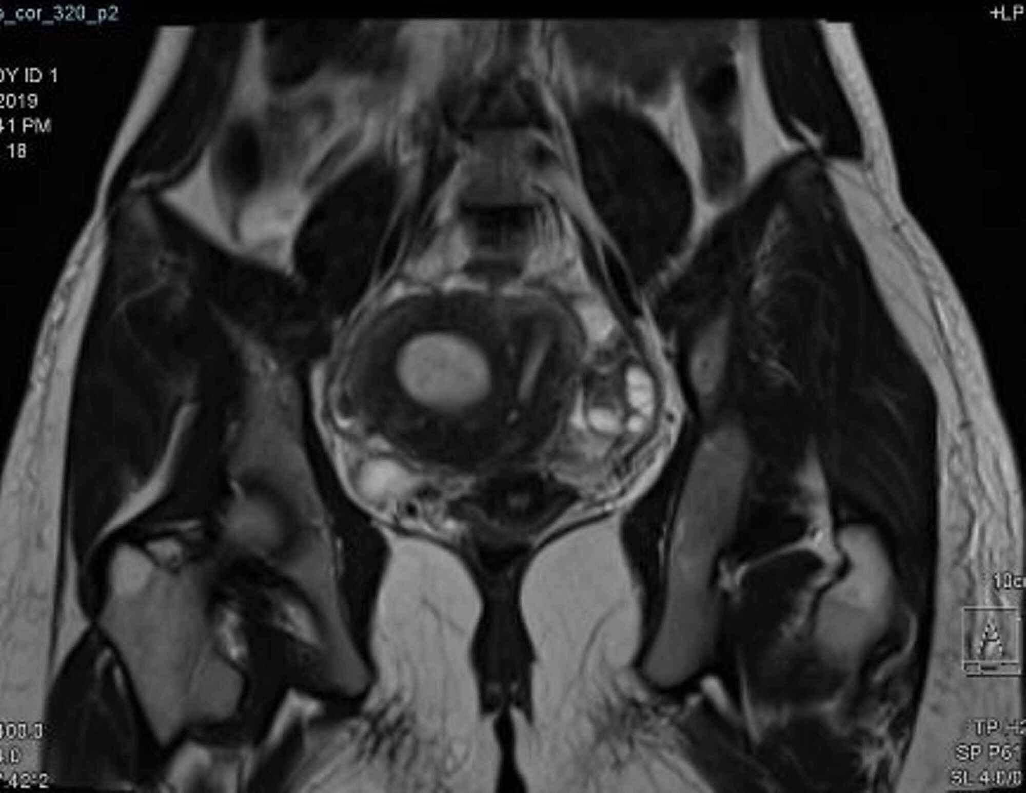 Cureus Laparoscopic Approach Towards Functional