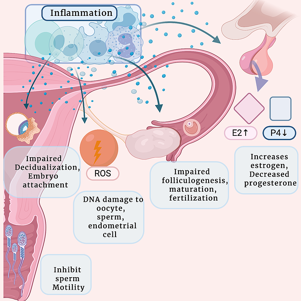 Cureus Inflammation to Infertility Panoramic View on Endometriosis