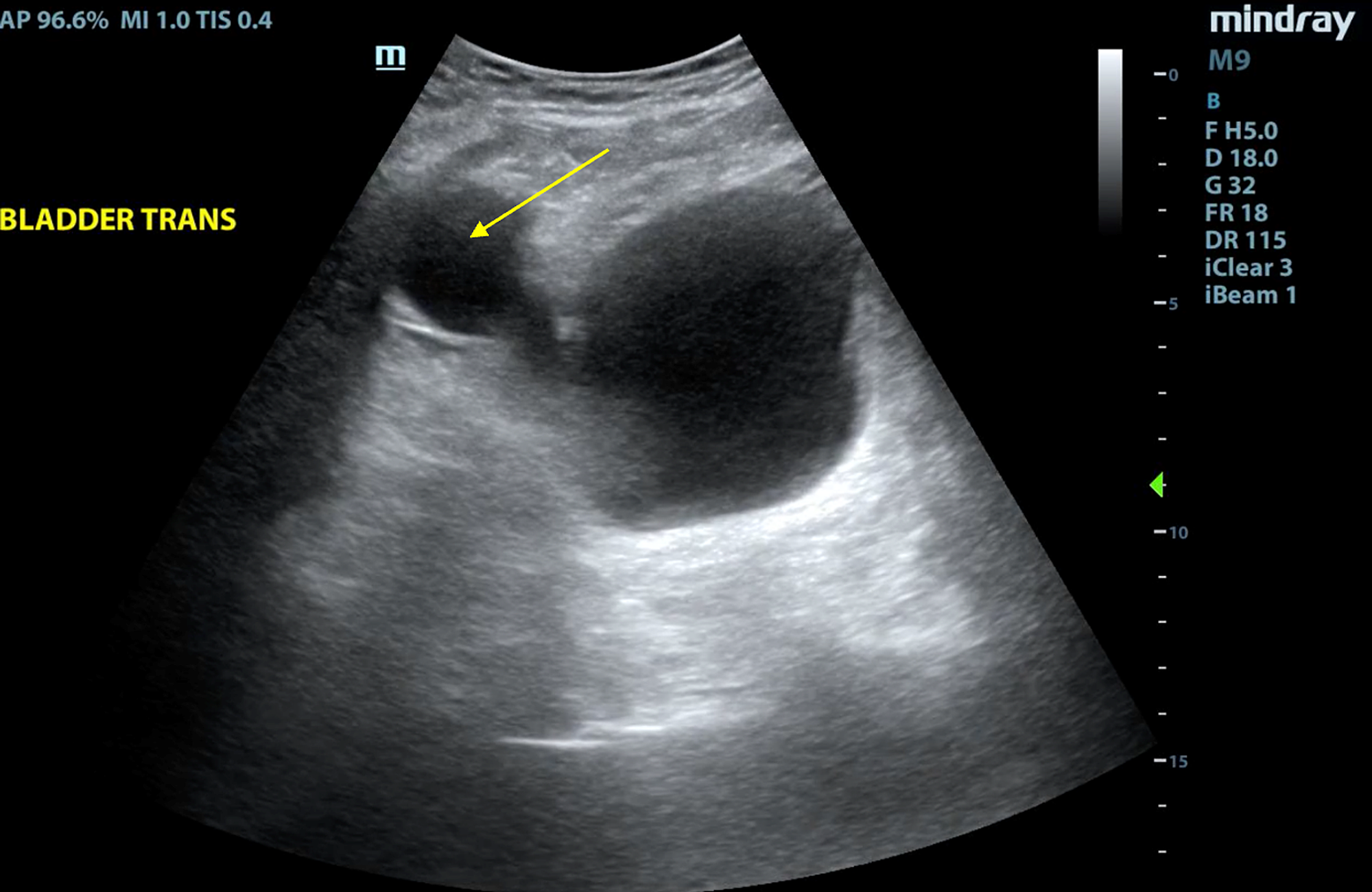 Cureus Urinary Retention In A Patient With An Artificial Urinary Sphincter A Case Report Of A 6088