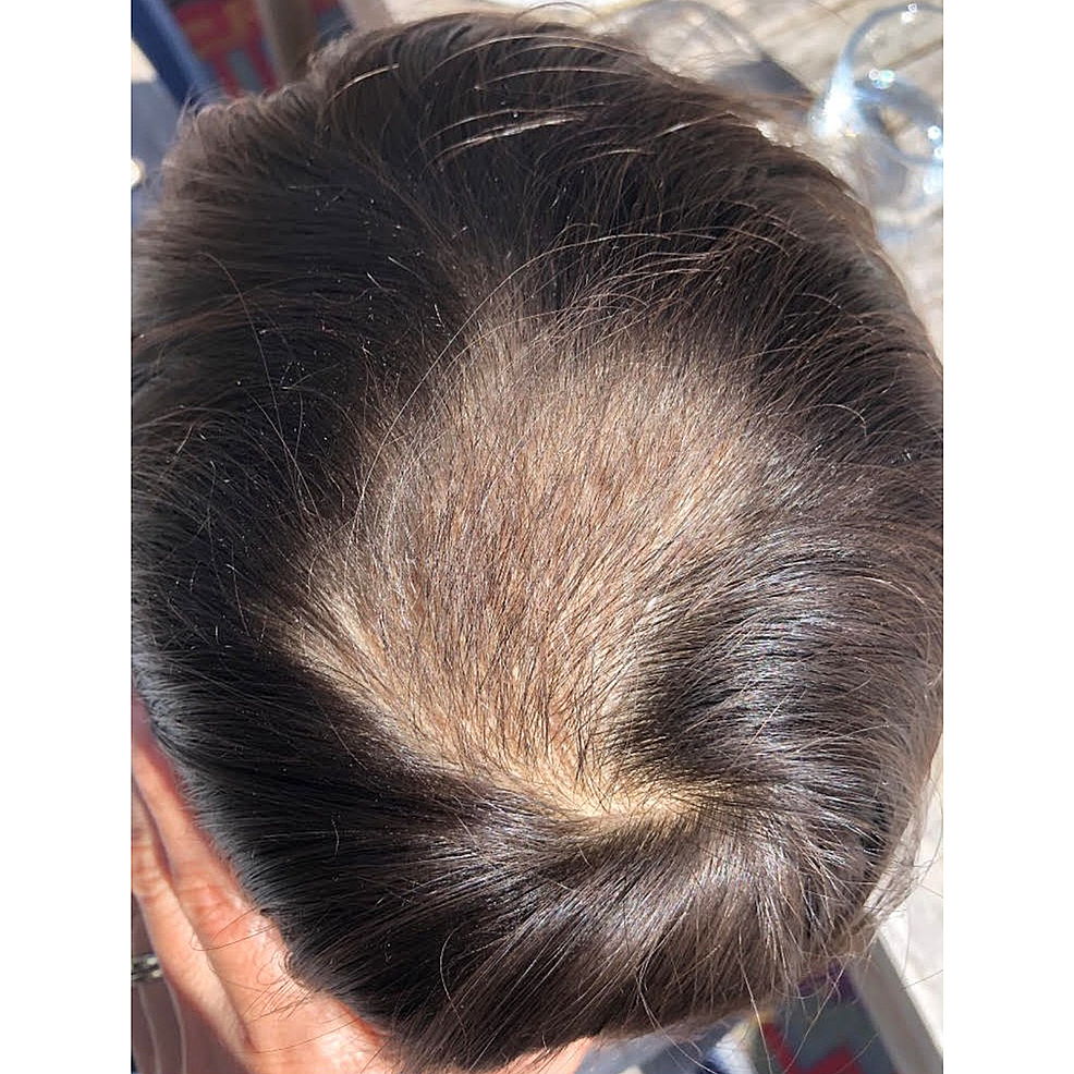 Patient-hair-regrowth-at-two-months
