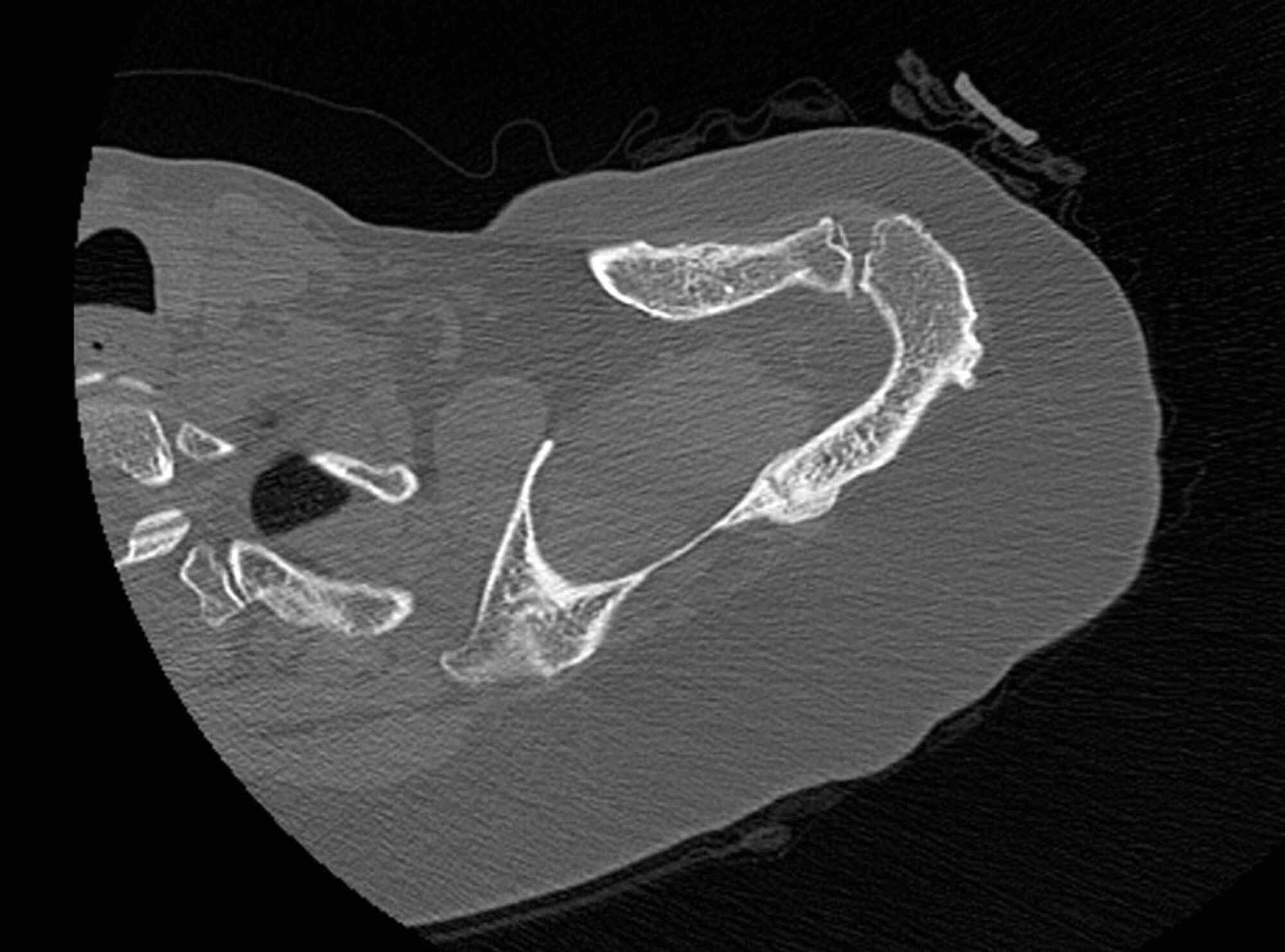 Cureus Scapular Spine Stress Fracture Following Reverse Total