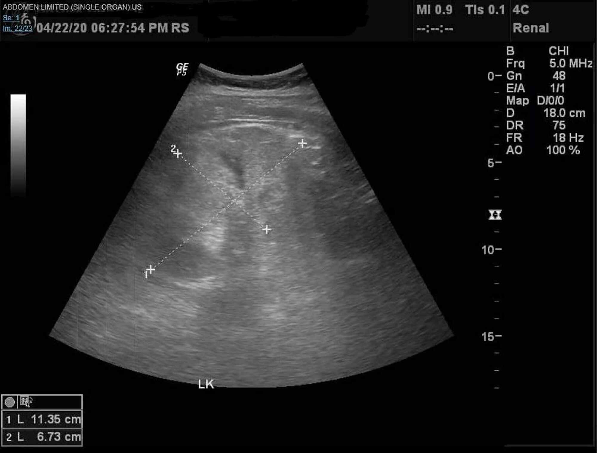 Cureus | Severe Acute Respiratory Syndrome Coronavirus 2 Induced Focal ...