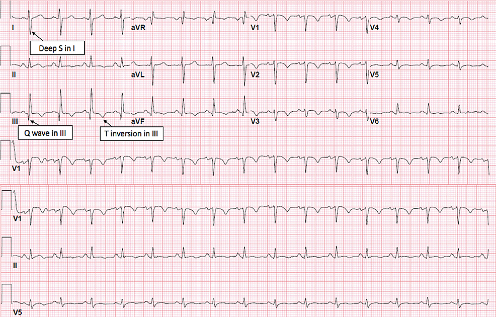 Bilateral Popliteal Vein Thrombosis, Acute Pulmonary Embolism and Mild ...