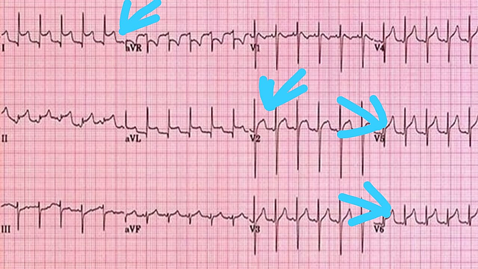 Acute Pericarditis and Pericardial Effusion in a Hypertensive COVID19 Patient Cureus