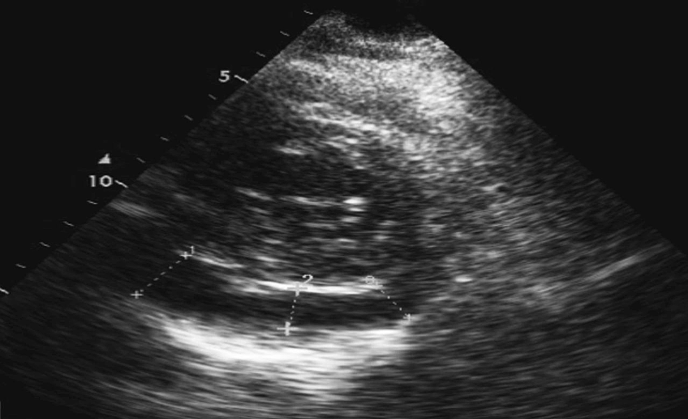 Cureus | Acute Pericarditis and Pericardial Effusion in a Hypertensive ...