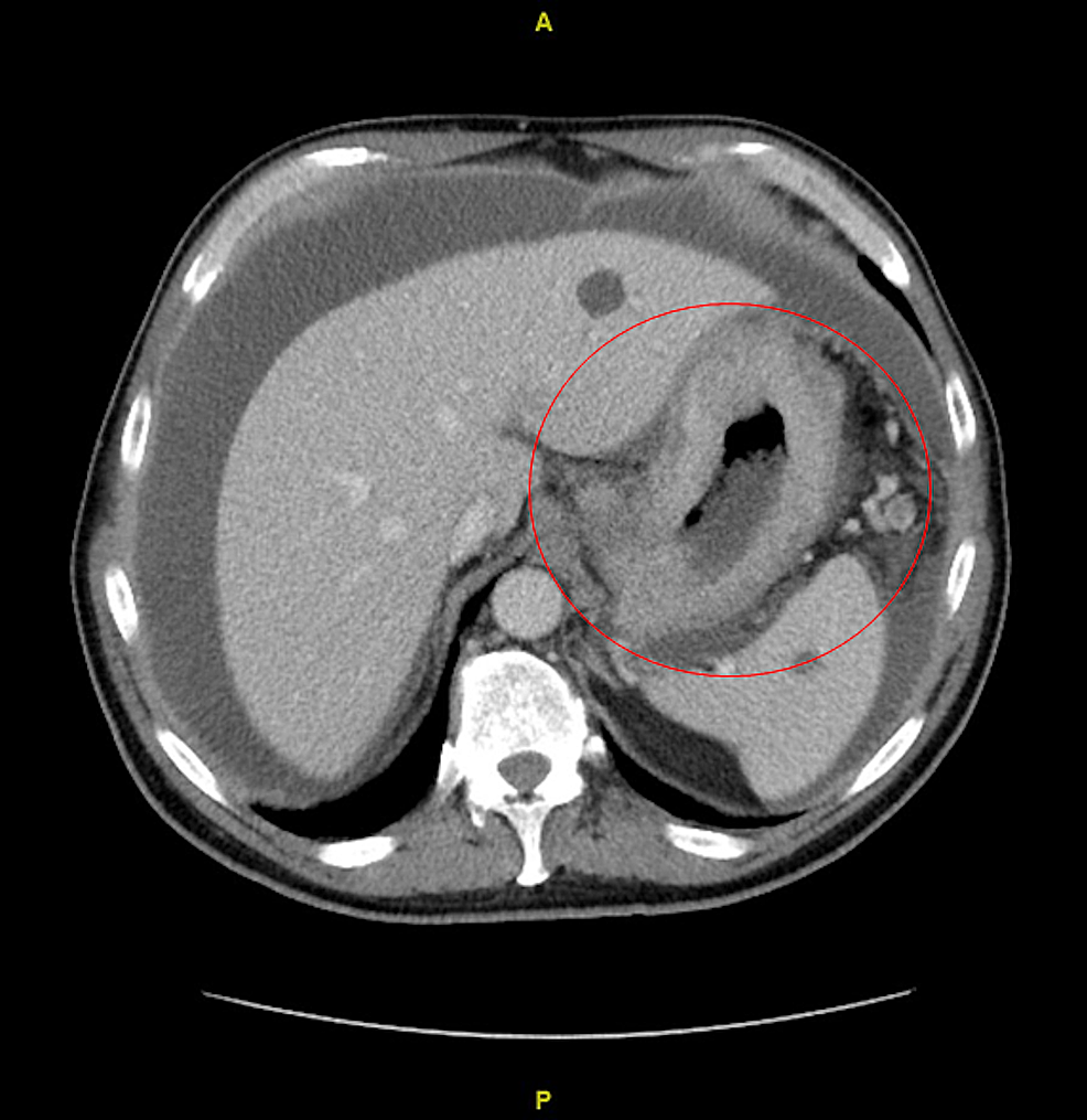 Cureus | A Unique Case of Alpha-Fetoprotein-Negative Hepatoid ...