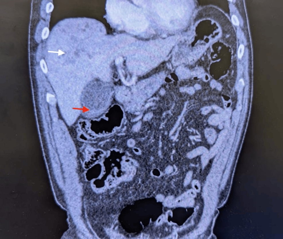 A Complex Case of Acalculous Cholecystitis, Cholangitis, and Pancreatitis Managed With Percutaneous Cholecystostomy in a Septic Patient
