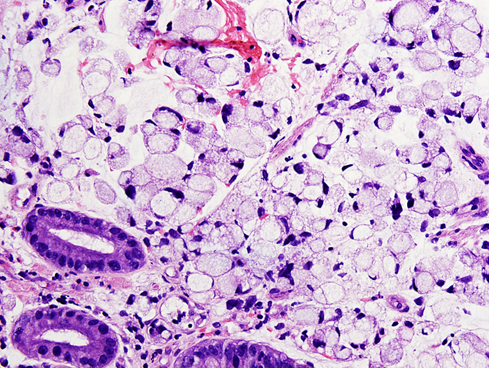 Cureus A Unique Case of AlphaFetoproteinNegative Hepatoid