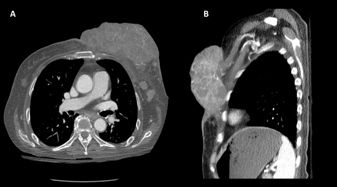 Cureus Durable Local Control Following Concurrent Hypofractionated Chemoradiation For A Massive Inflammatory Breast Cancer Chest Wall Recurrence
