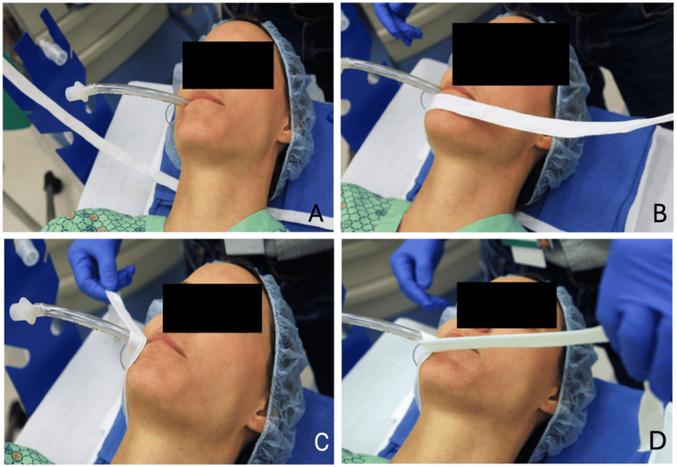 Sequence-of-steps-(A-D)-to-tie-an-endotracheal-tube-(ETT).