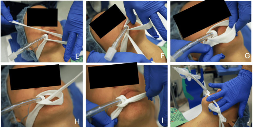 Sequence-of-steps-(E-J)-to-tie-an-endotracheal-tube.