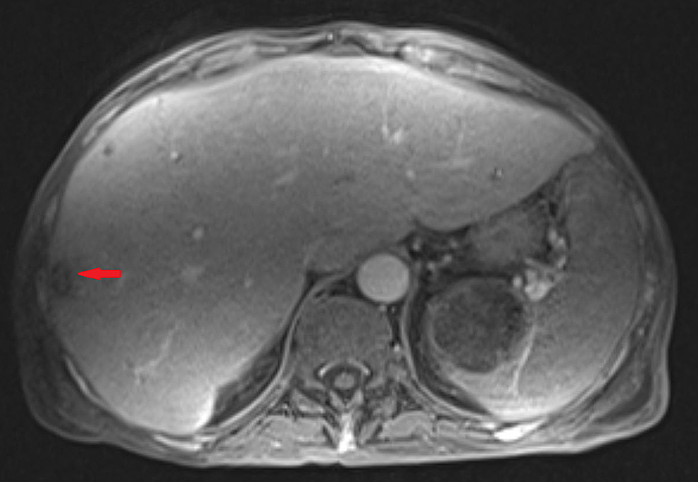 MRI-of-the-liver-showing-a-nodular-hepatic-lesion-(red-arrow).