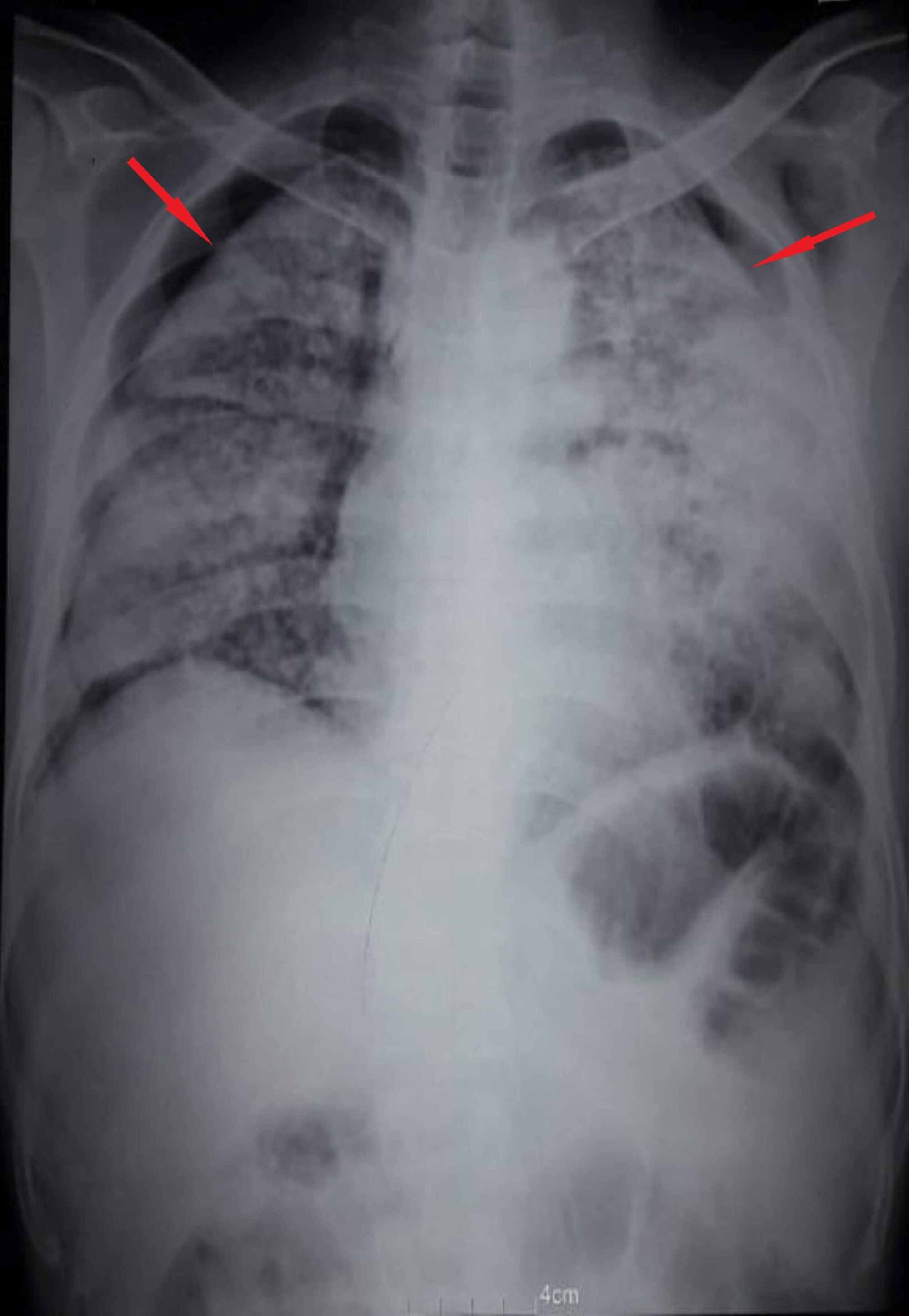 Chest X Ray With Pneumothorax