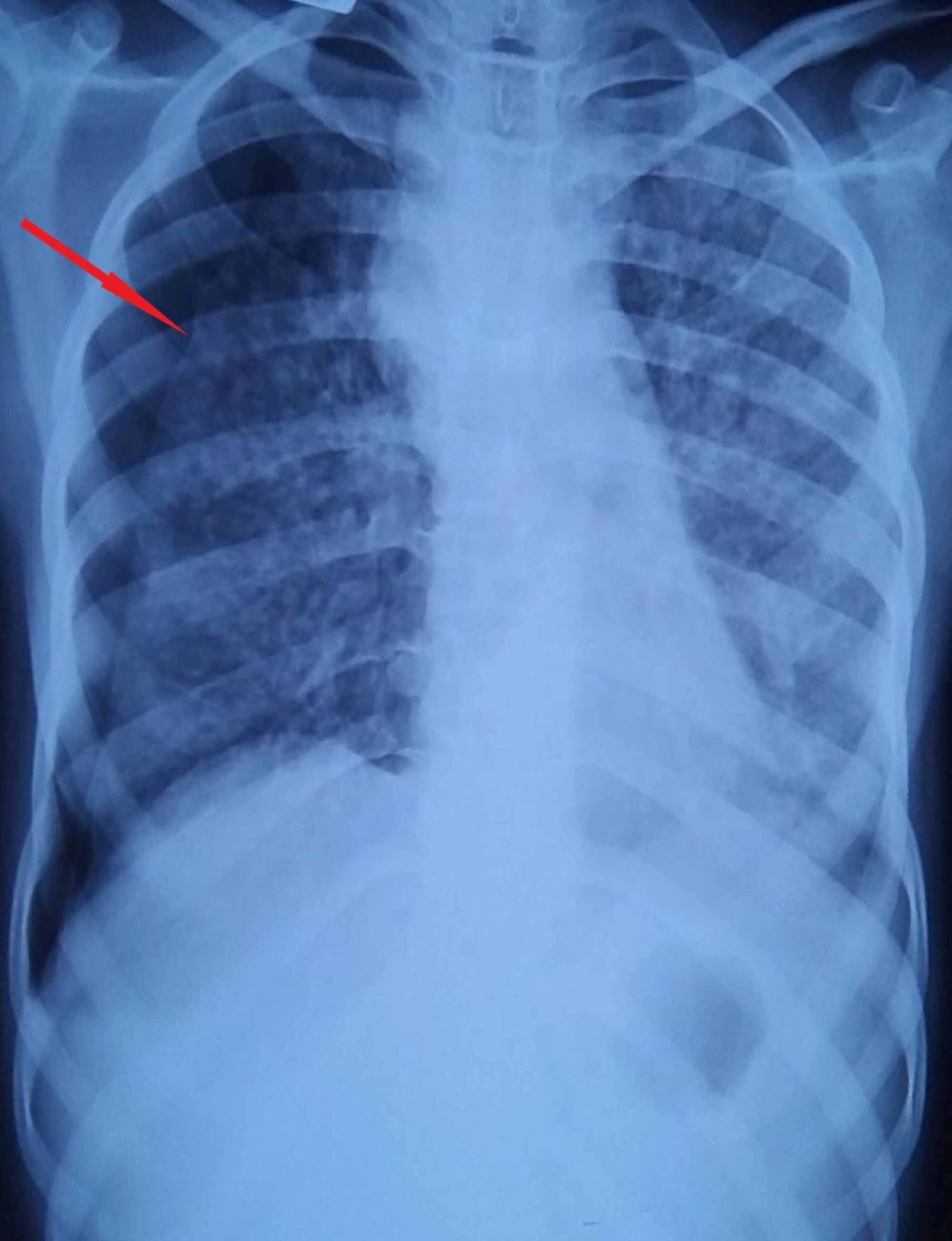 Cureus | Silicosis With Secondary Spontaneous Pneumothorax in the ...