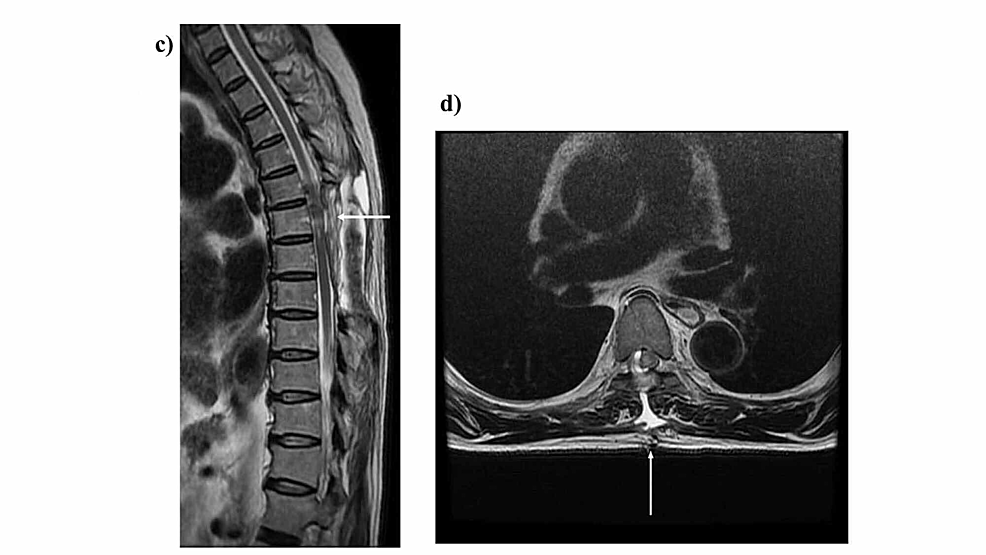 Thoracic-spine-intradural-extramedullary-tumor-(Th6).-Postoperative-images.
