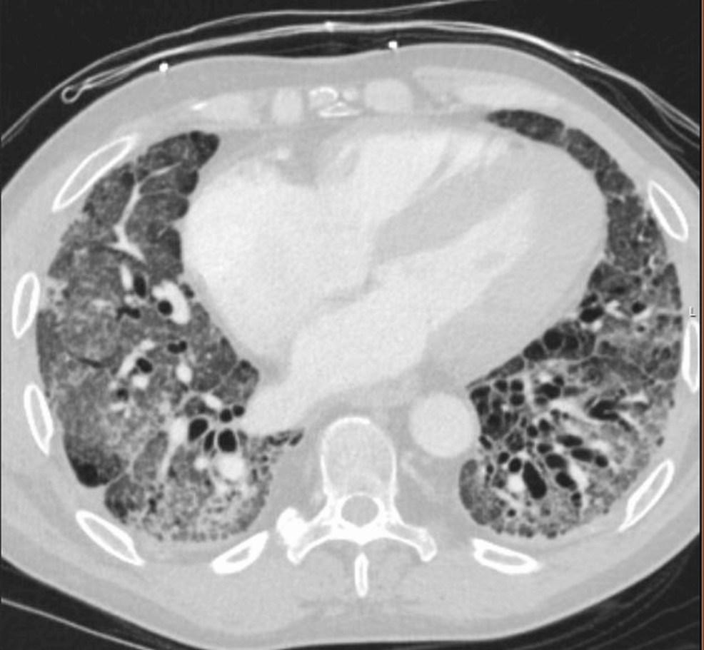 Axial-chest-CT. Axial-chest-CT.