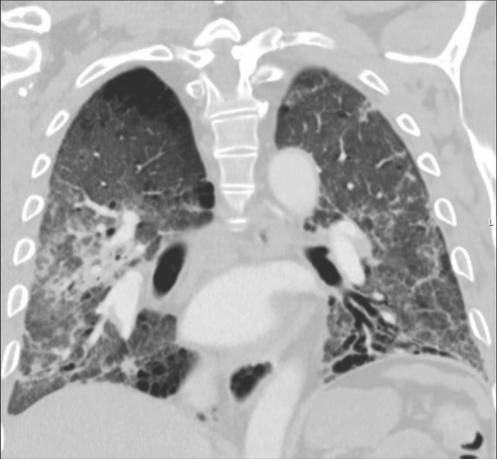 Coronal-chest-CT. Coronal-chest-CT.