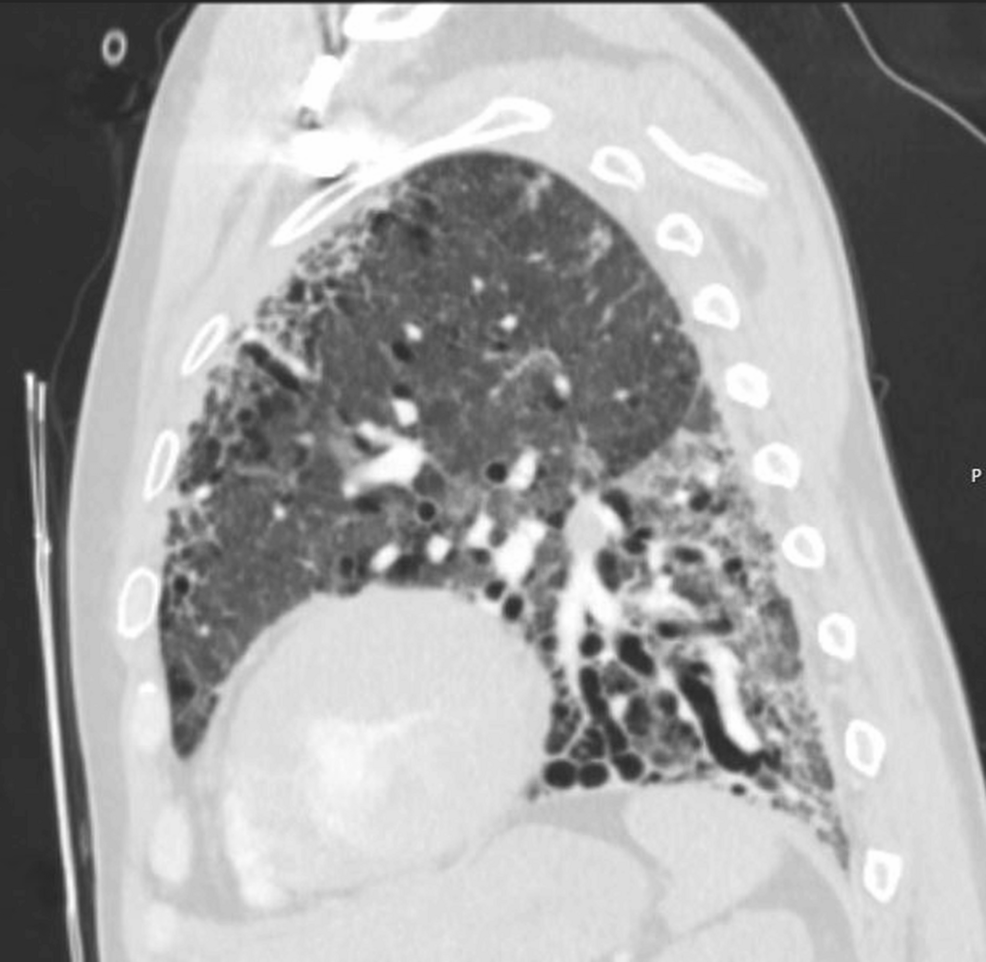 Sagittal-chest-CT. Sagittal-chest-CT.