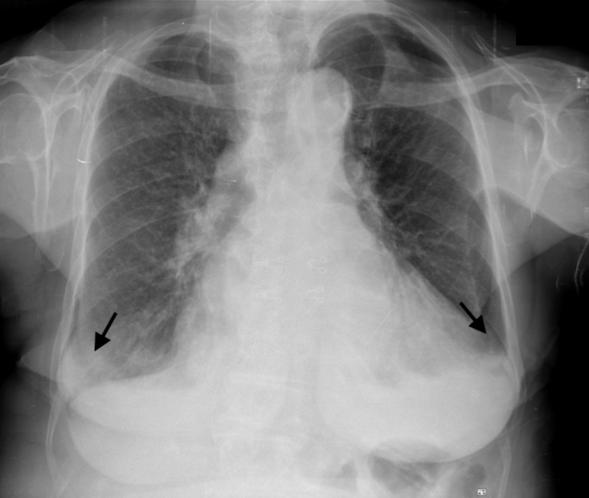 Cureus | Anthracycline Cardiotoxicity in a Patient with Diffuse Large B ...