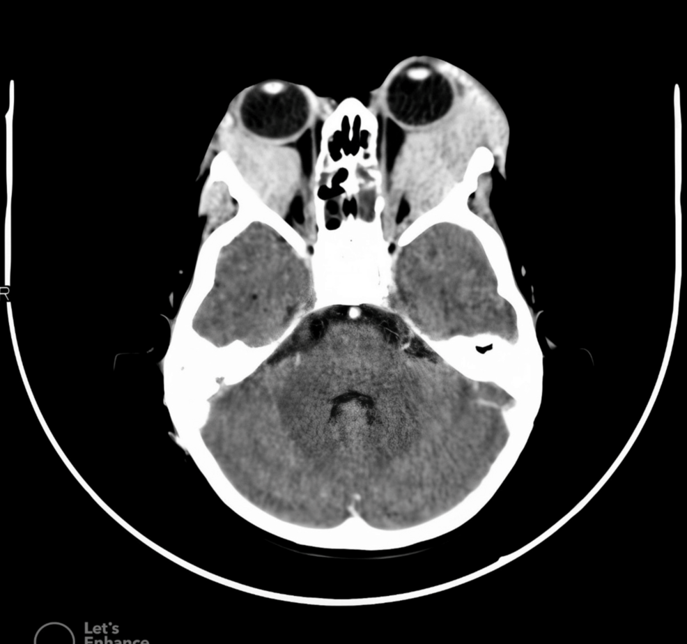 Conservative Management of a Slow-Flow Orbital Cavernous Hemangioma: A Case  Report, image size:986x924