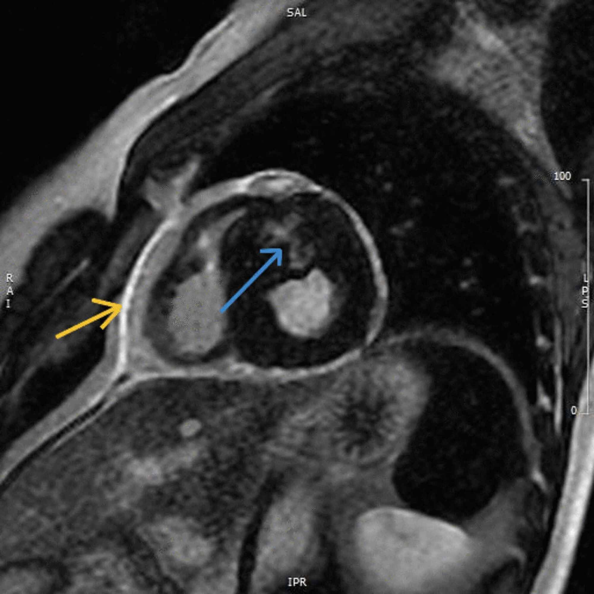 Cureus | Two Birds With One Stone: The Decisive Role Of Cardiac MRI In ...