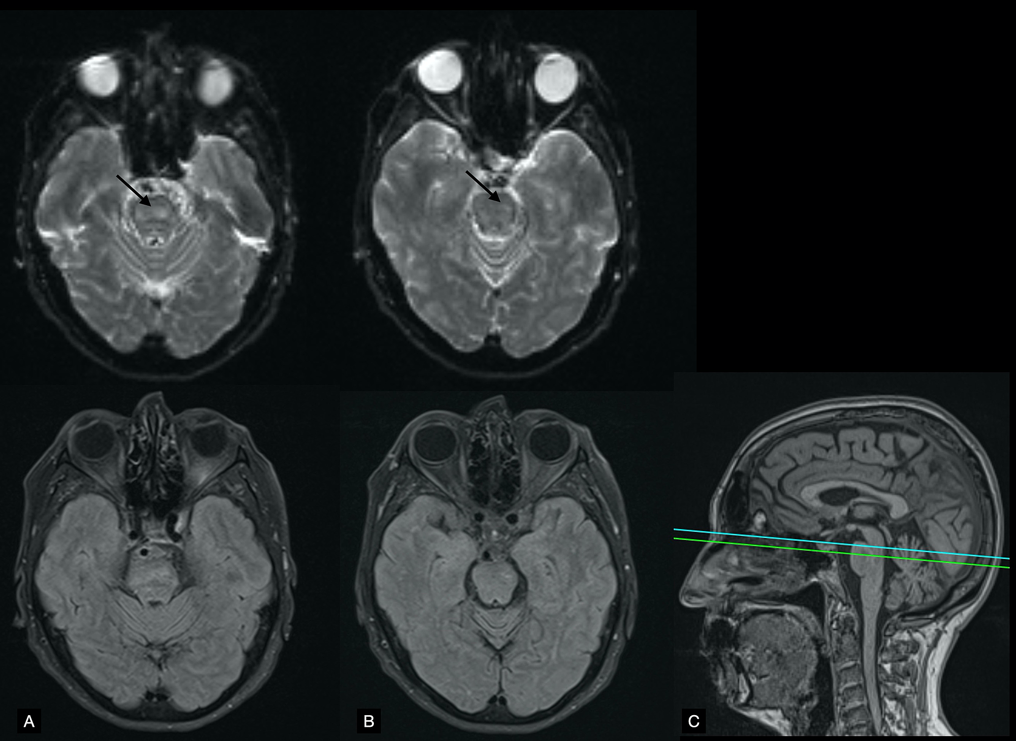 Cureus | Brainstem Stroke Presenting as Wake-Up Diplopia in a Patient ...