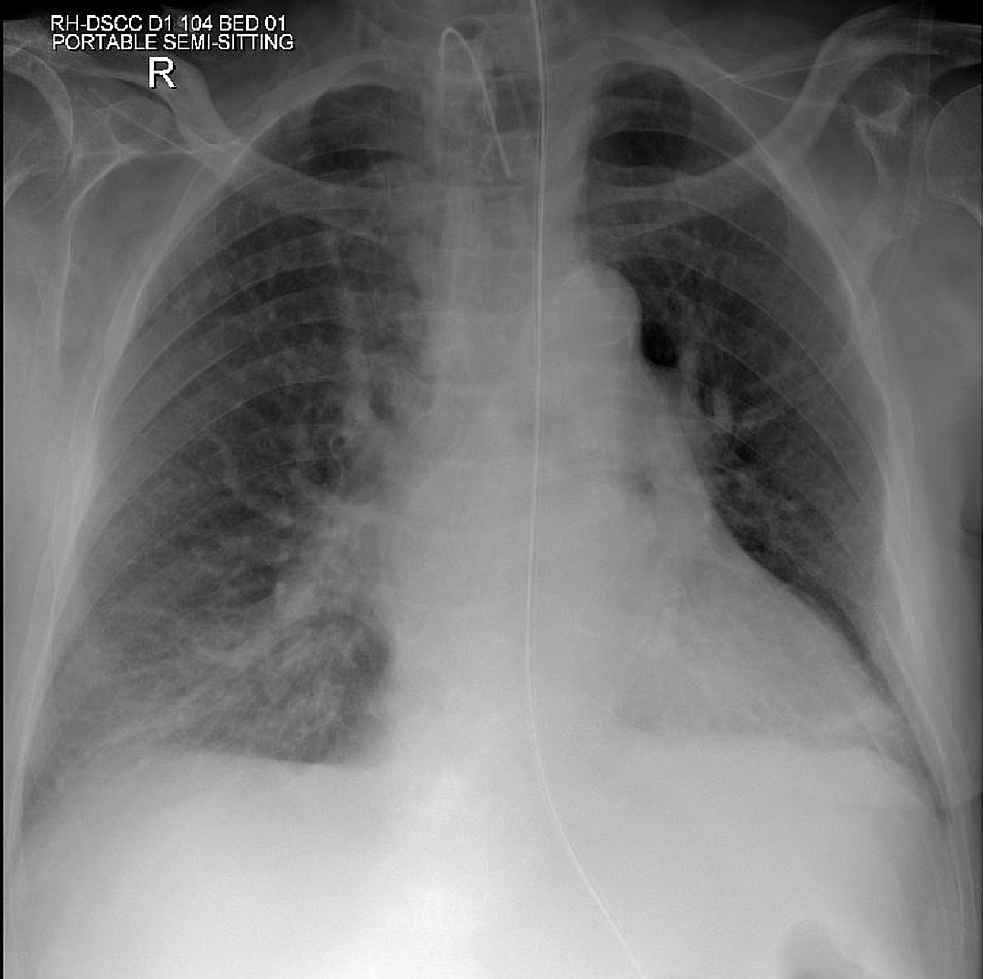 Chest X Ray Showing Tracheostomy Tube Superficial Ekg Electrodes And