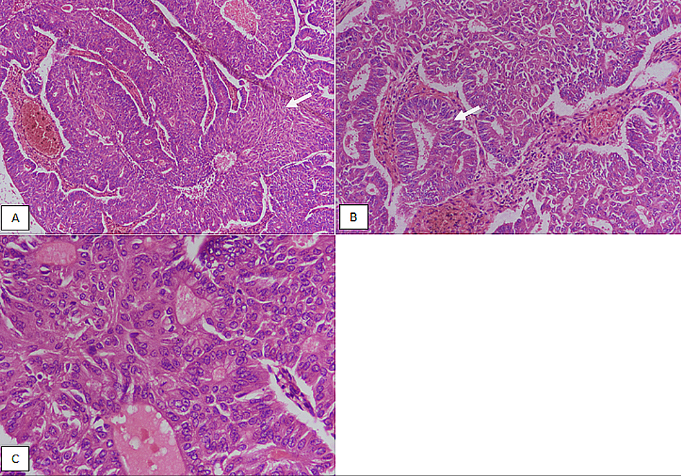 cureus-morphological-spectrum-and-pathological-parameters-of-type-2