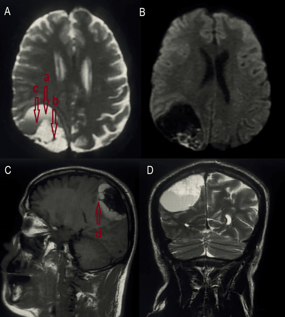 PPT - Orbital Lymphangioma (Kennerdell Case 3) PowerPoint Presentation -  ID:5571955, image size:986x1095